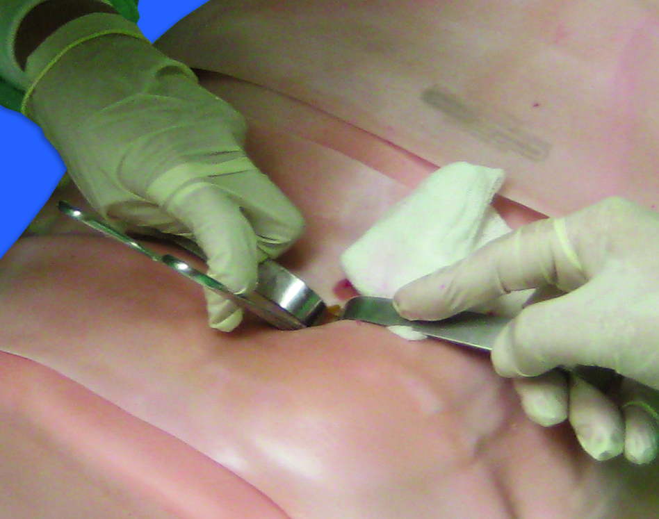 Diagnostic Peritoneal Lavage