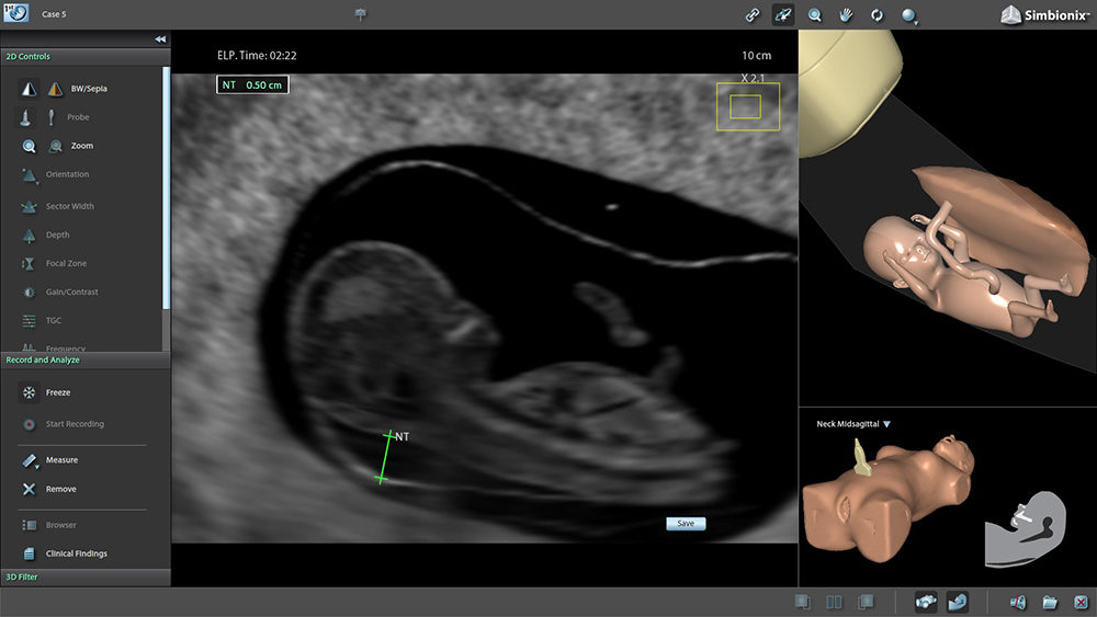 DEVELOPMENT OF PREGNANCY SIMULATOR PROVIDED WITH A.I. AND